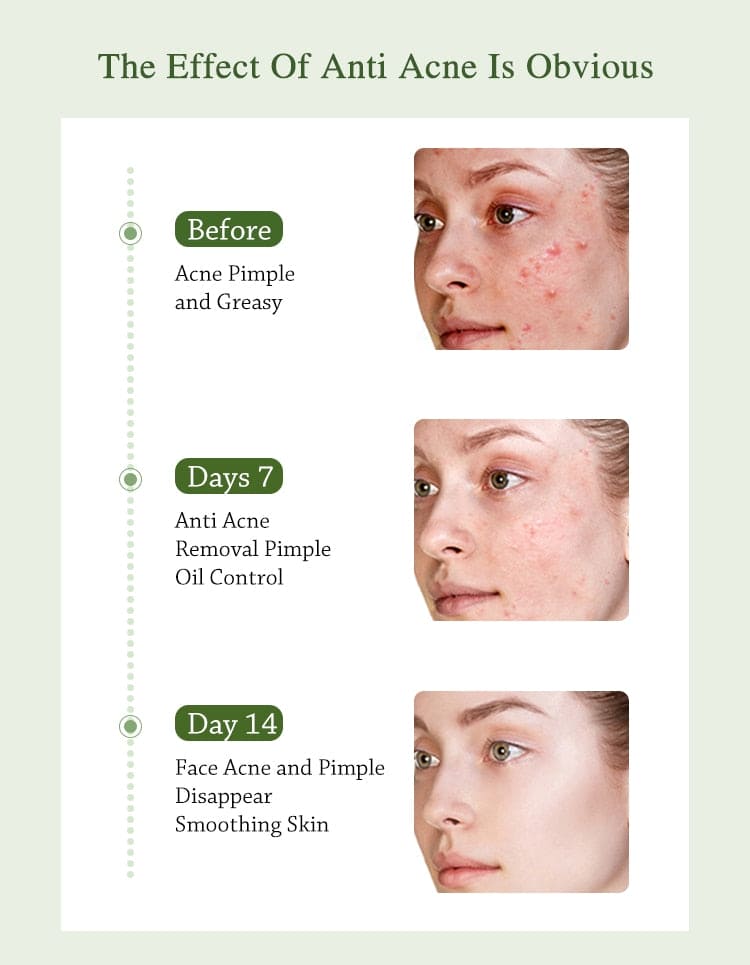 Acne Face Cream Herbal Pimple Scar Removal Shrink Pore Oil Moisturizing Treatmen