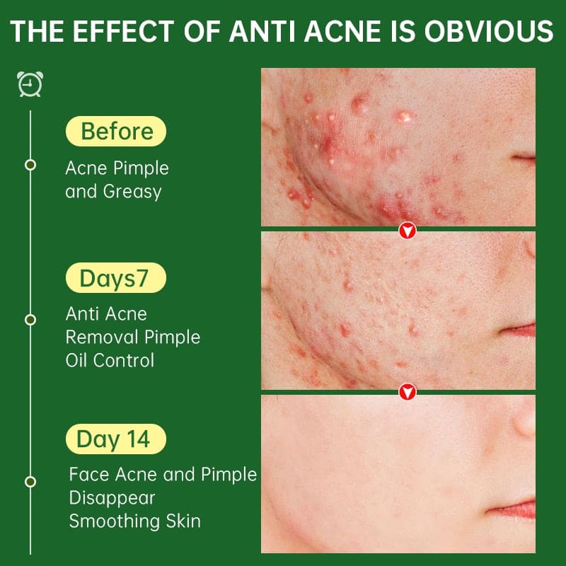 Acne Face Cream Herbal Pimple Scar Removal Shrink Pore Oil Moisturizing Treatmen