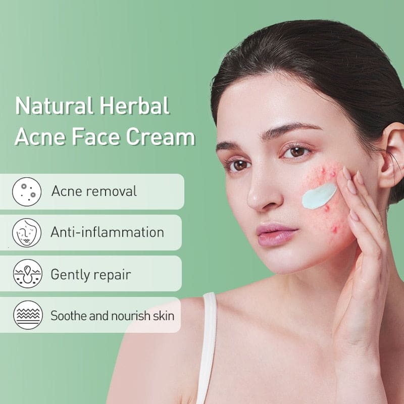 Acne Face Cream Herbal Pimple Scar Removal Shrink Pore Oil Moisturizing Treatmen