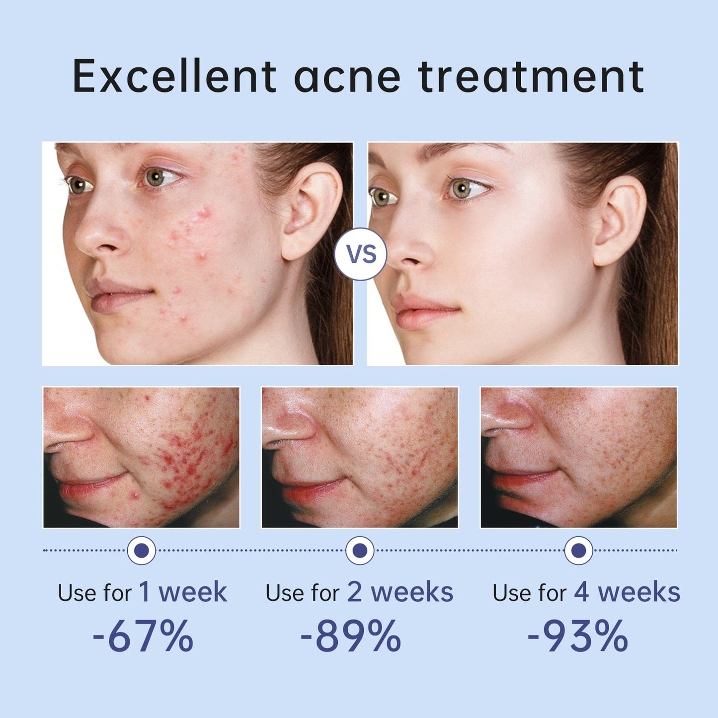 Acne Treatment Gel Cream Pimple Spot Removal Oil For Skin Scars & Pores