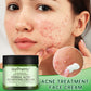 Acne Face Cream Herbal Pimple Scar Removal Shrink Pore Oil Moisturizing Treatmen