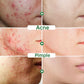 Acne Face Cream Herbal Pimple Scar Removal Shrink Pore Oil Moisturizing Treatmen