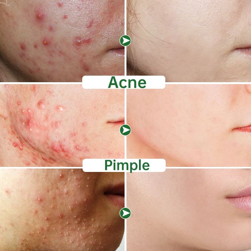 Acne Face Cream Herbal Pimple Scar Removal Shrink Pore Oil Moisturizing Treatmen