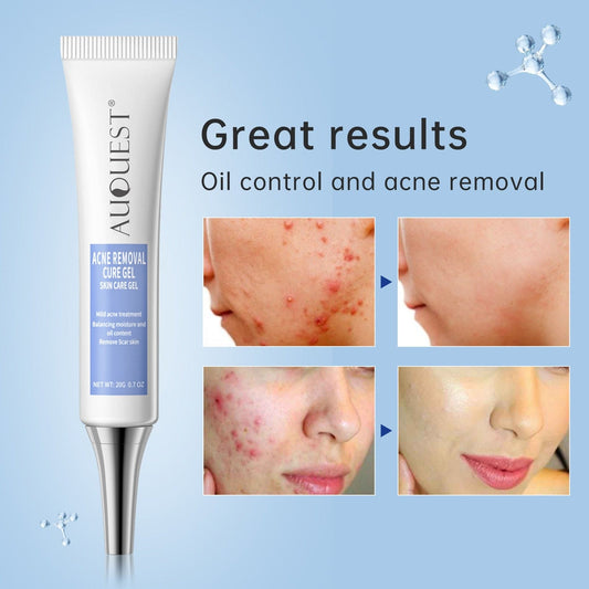 Acne Treatment Gel Cream Pimple Spot Removal Oil For Skin Scars & Pores