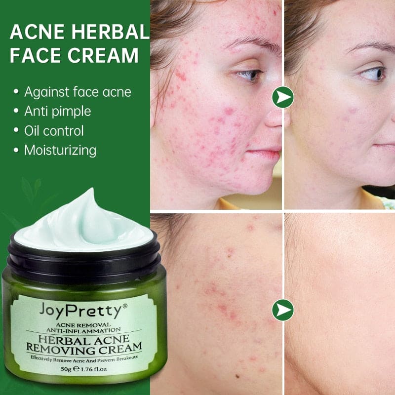 Acne Face Cream Herbal Pimple Scar Removal Shrink Pore Oil Moisturizing Treatmen